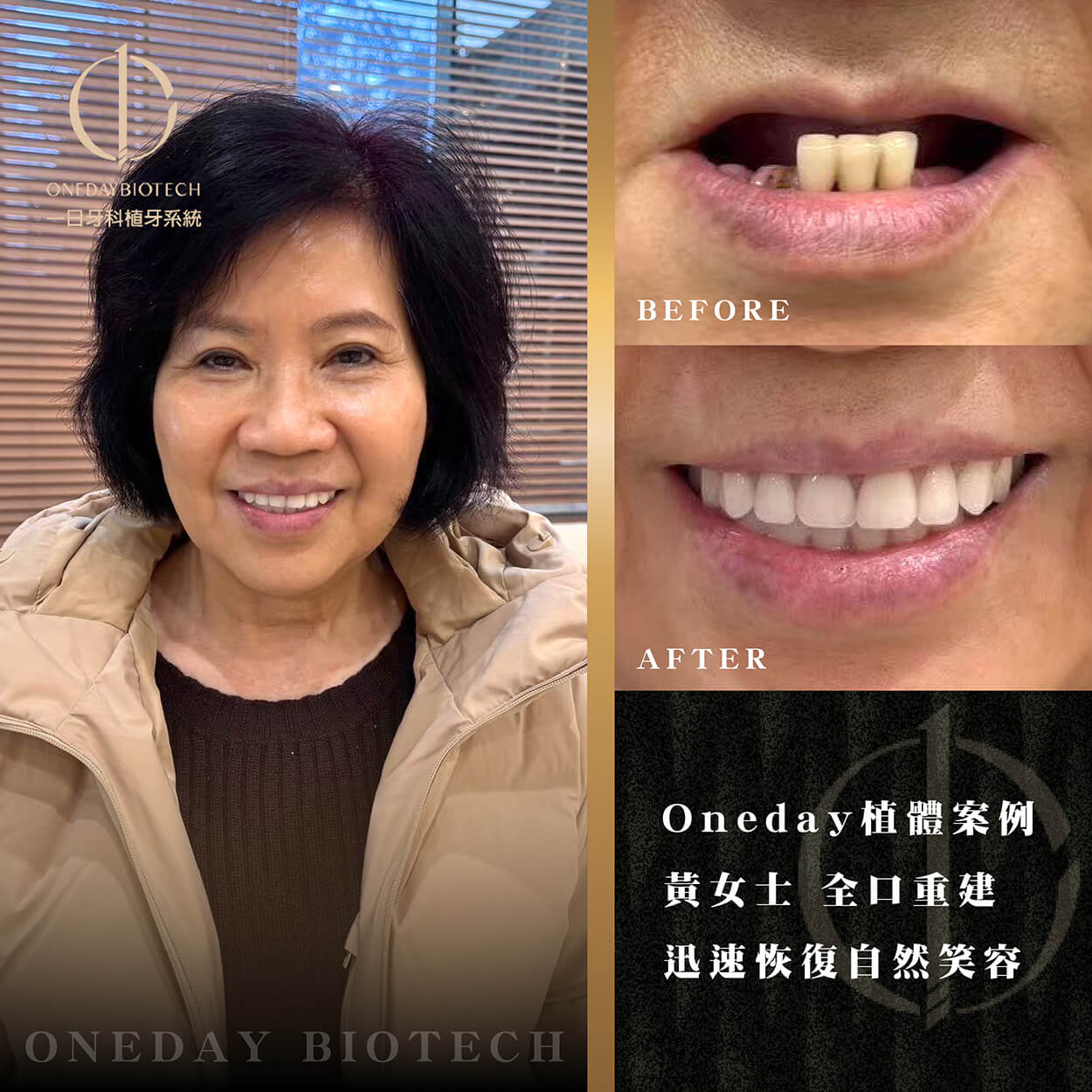 OneDay Implant．完美微笑三步驟