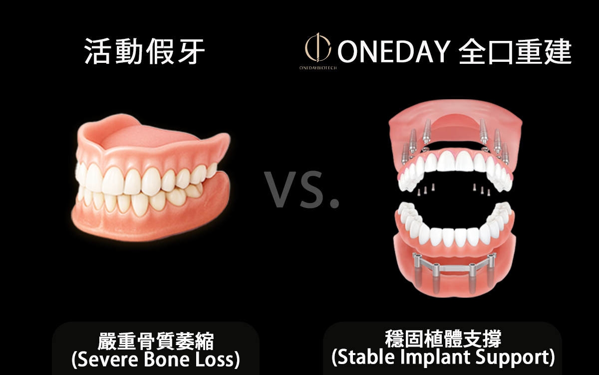 告別活動假牙的最後一站：OneDay 全口重建如何用「一日」找回您的咬合力？